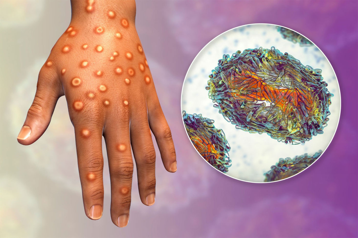 Maymun Çiçeği Hastalığı